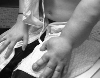 Study shows nanofiber scaffolds could treat lymphedema by rerouting lymphatic system around blockage